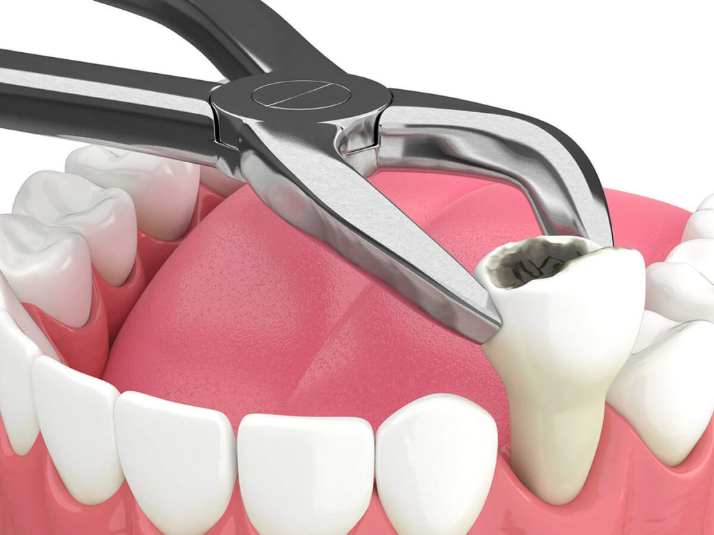 Tooth extractions in Daphne, AL at Eastern Shore Dental Associates