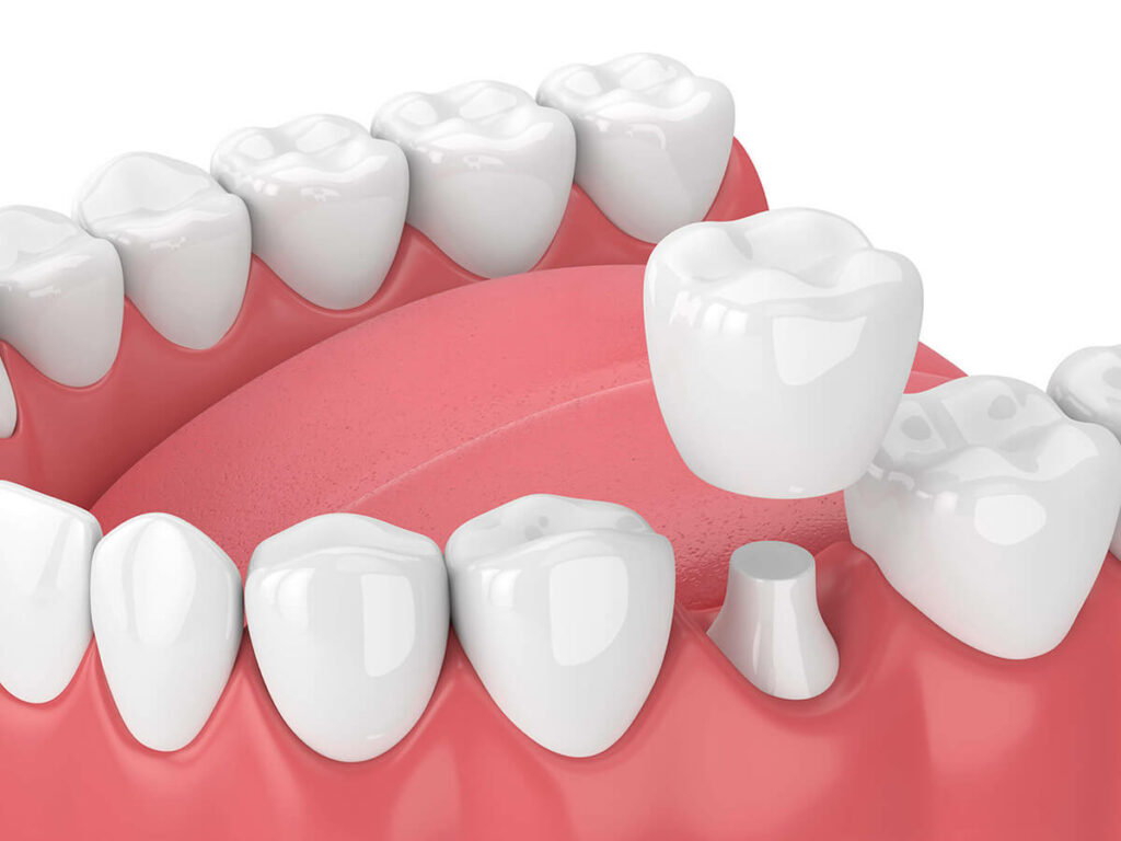 Dental crowns and bridges in Daphne, AL at Eastern Shore Dental Associates