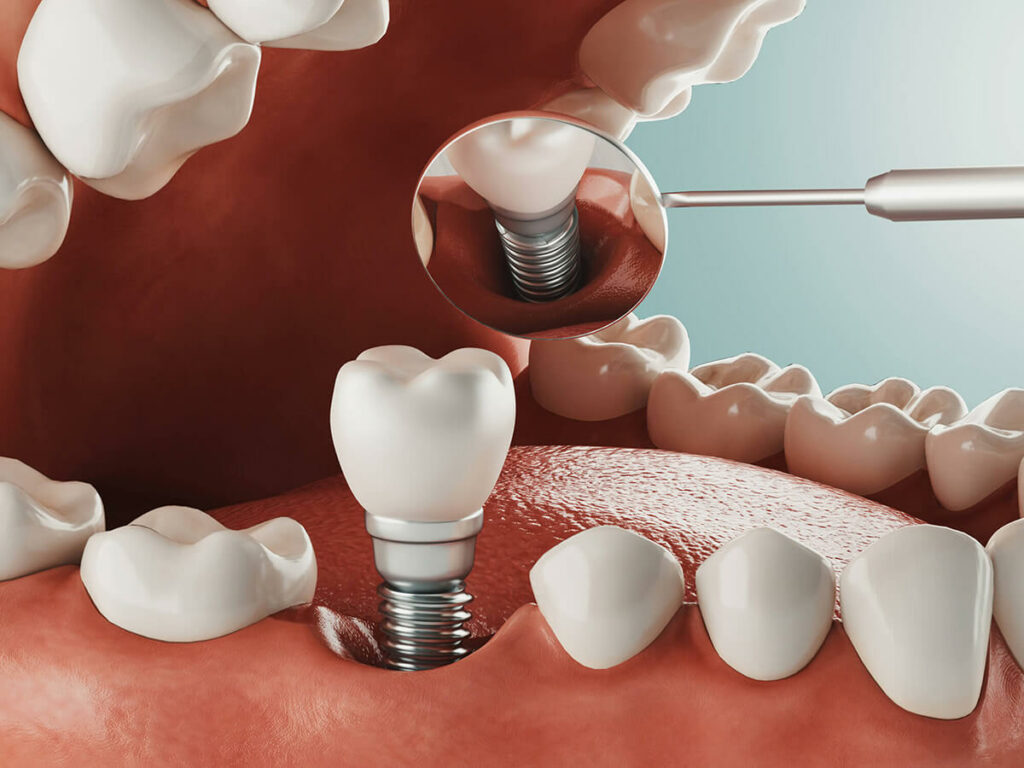 Dental implants in Daphne, AL at Eastern Shore Dental Associates