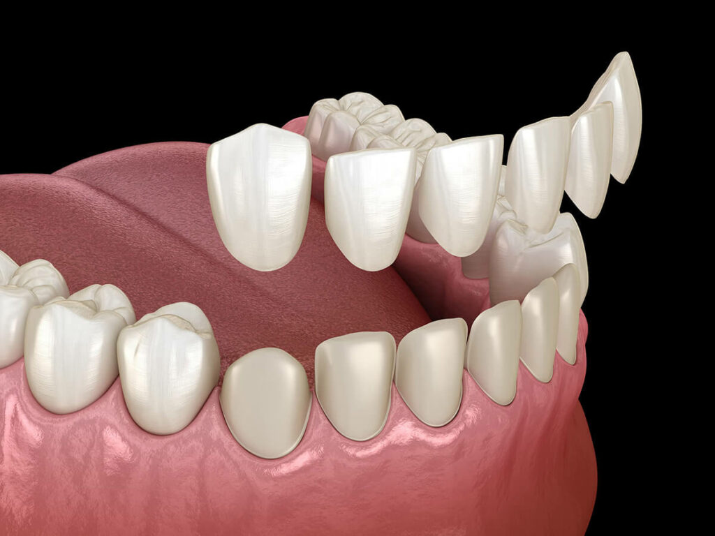 Dental veneers in Daphne, AL at Eastern Shore Dental Associates
