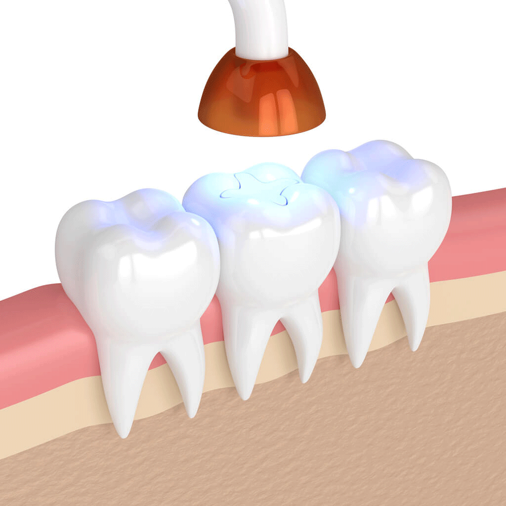 Tooth fillings in Daphne, AL at Eastern Shore Dental Associates