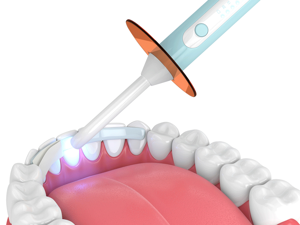 Dental bonding in Daphne, AL at Eastern Shore Dental Associates