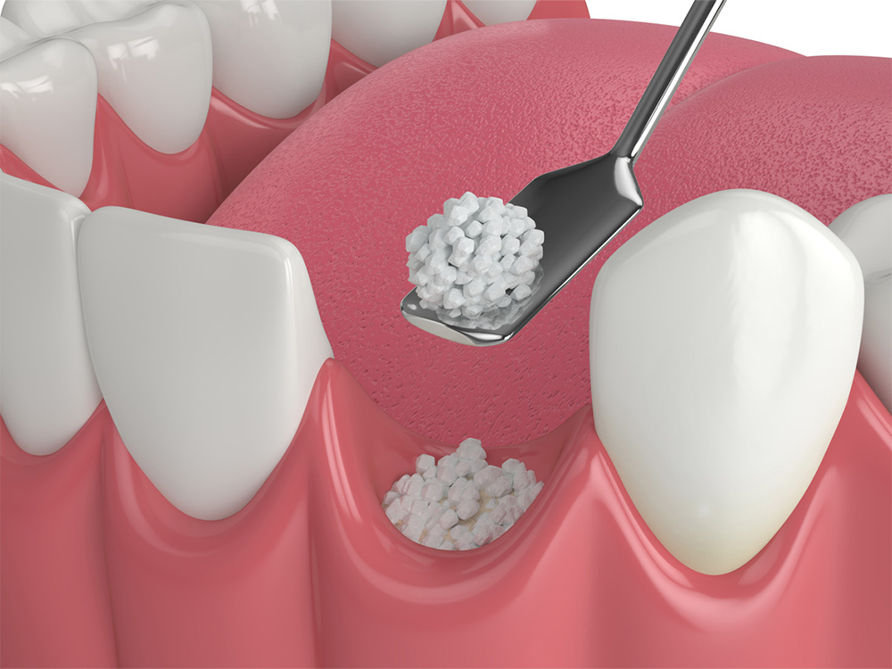 Dental bone grafting in Daphne, AL at Eastern Shore Dental Associates