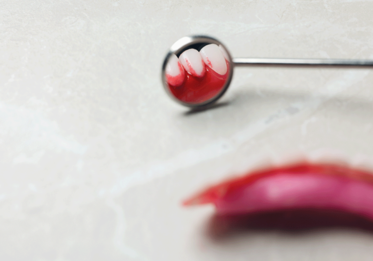 A dental mirror shows a close-up view of clean teeth and red gums, possibly indicating mild irritation. The surrounding area includes blurred dental equipment.